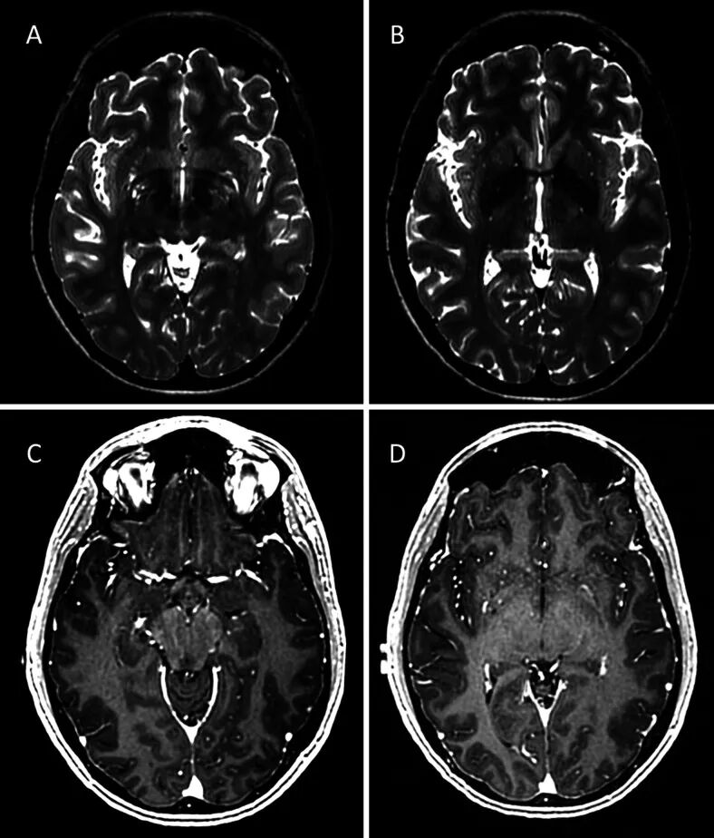 病例2,初次就诊时影像表现。A 和 B:轴位T2加权图像显示左侧岛叶内存在一膨胀性占位性病变。C 和 D:轴位T1加权增强后图像显示左侧大脑中动脉区域存在一线状异常强化区域。